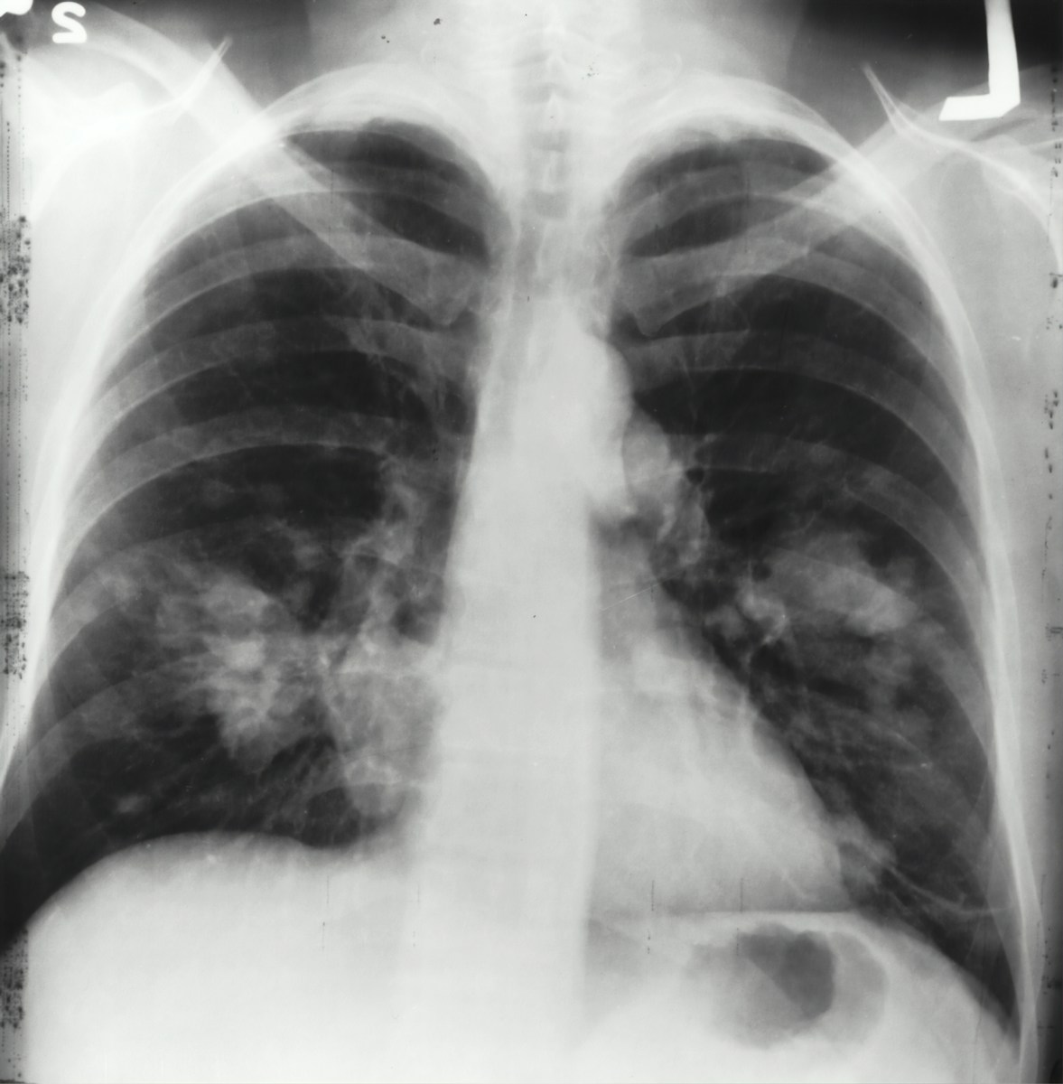 Lung cancer risk